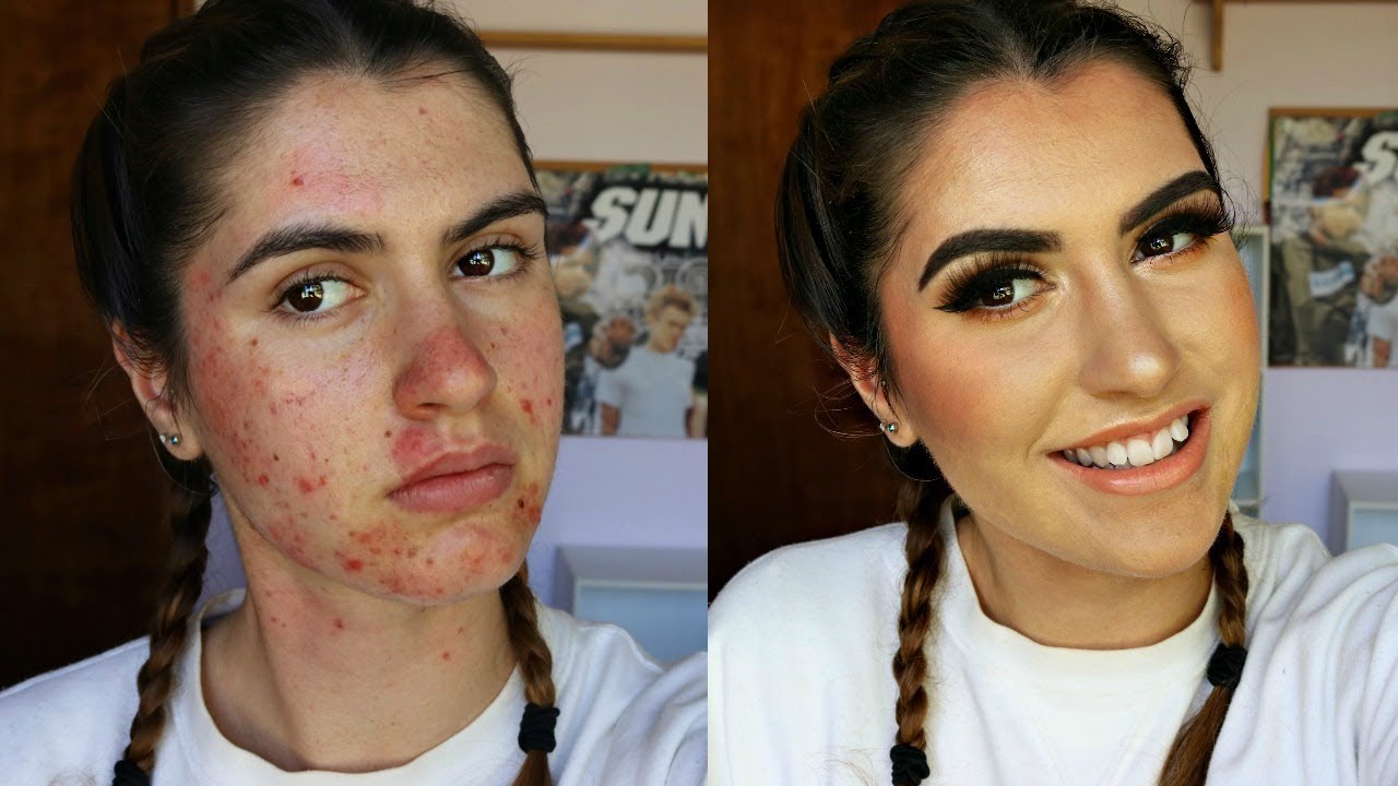 HOW TO COVER ACNE, SCARS & BREAKOUTS | Full Coverage w/ Drugstore Makeup