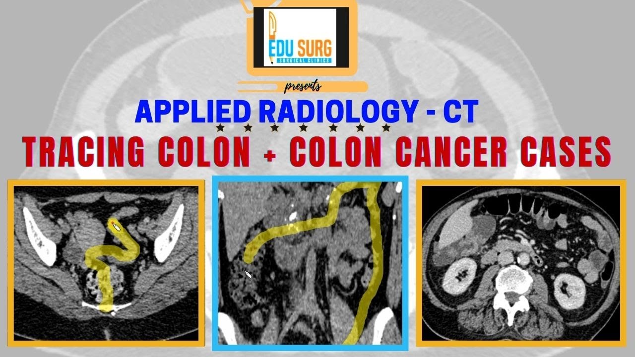 How to read CT scan abdomen - Colon, appendix