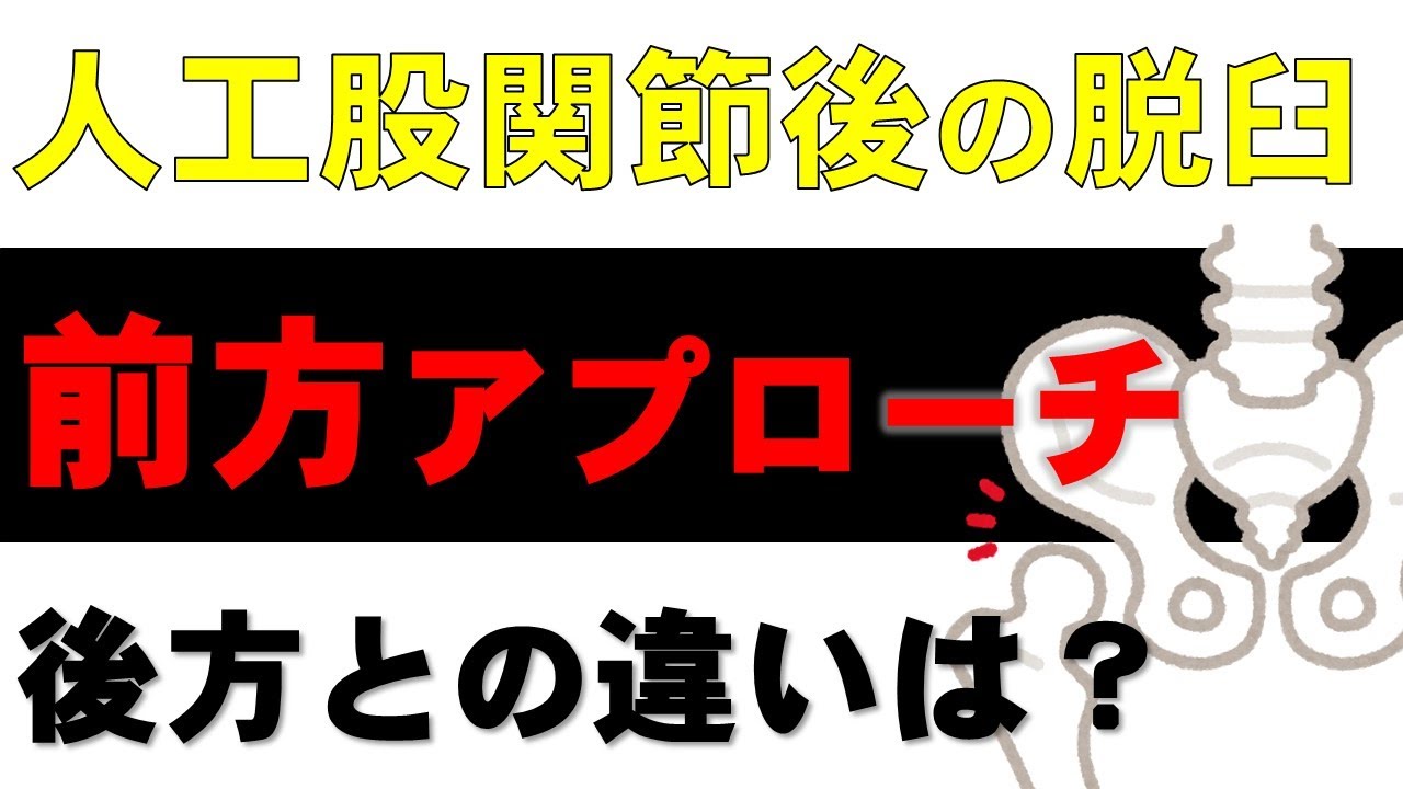 29. 前方アプローチでの人工股関節の術後脱臼について-後方アプローチとの違いを分かりやすく解説-