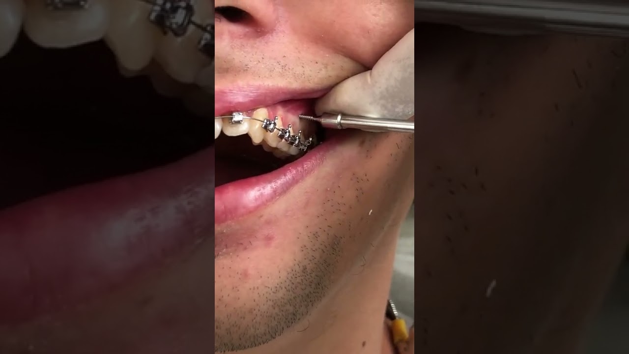 Mini-Implantes - O melhor e mais didatico vídeo de instalação.