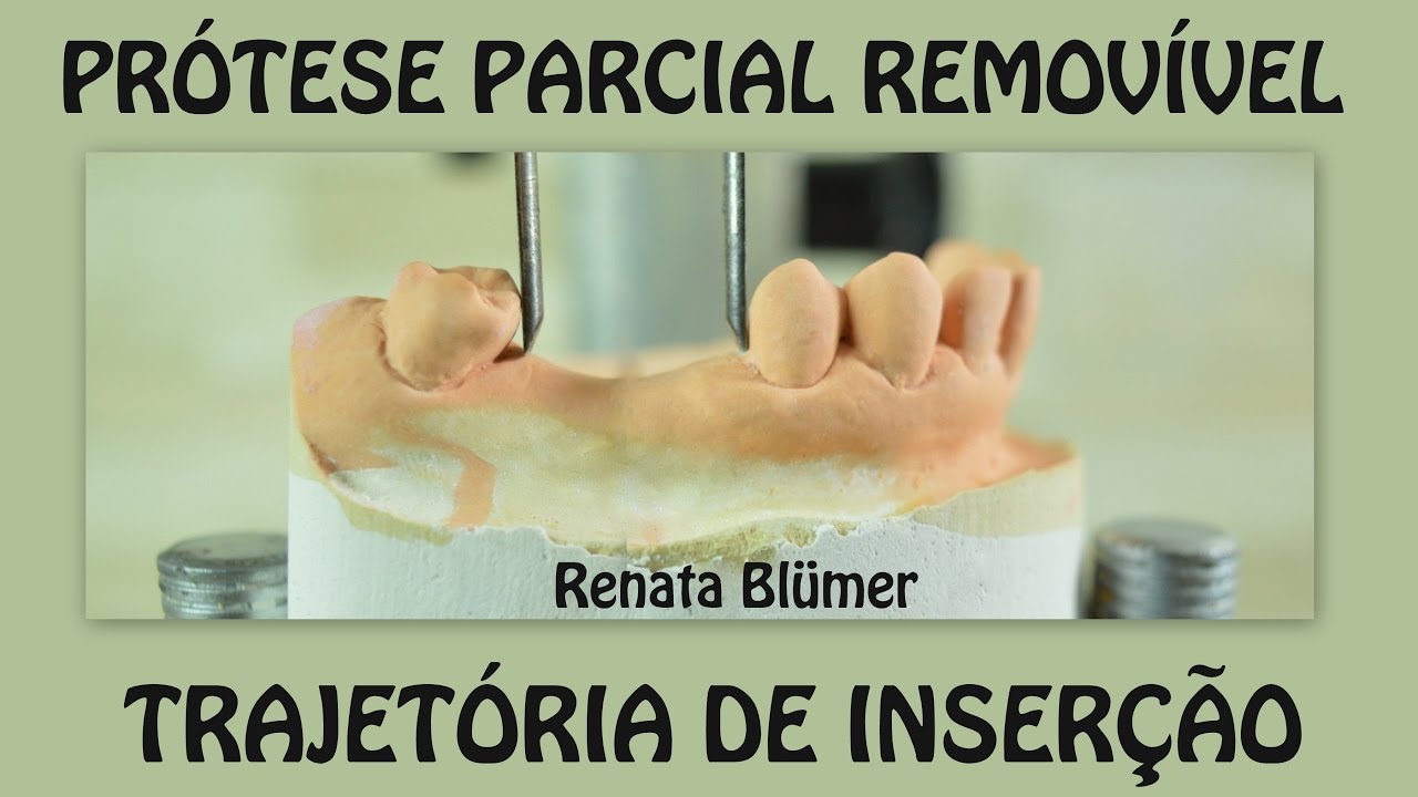 TRAJETÓRIA DE INSERÇÃO - DELINEAMENTO - PRÓTESE PARCIAL REMOVÍVEL *