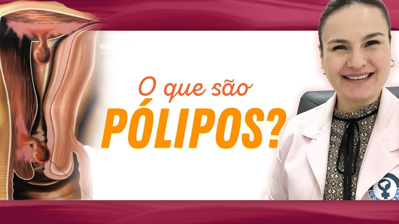 O que são PÓLIPOS?