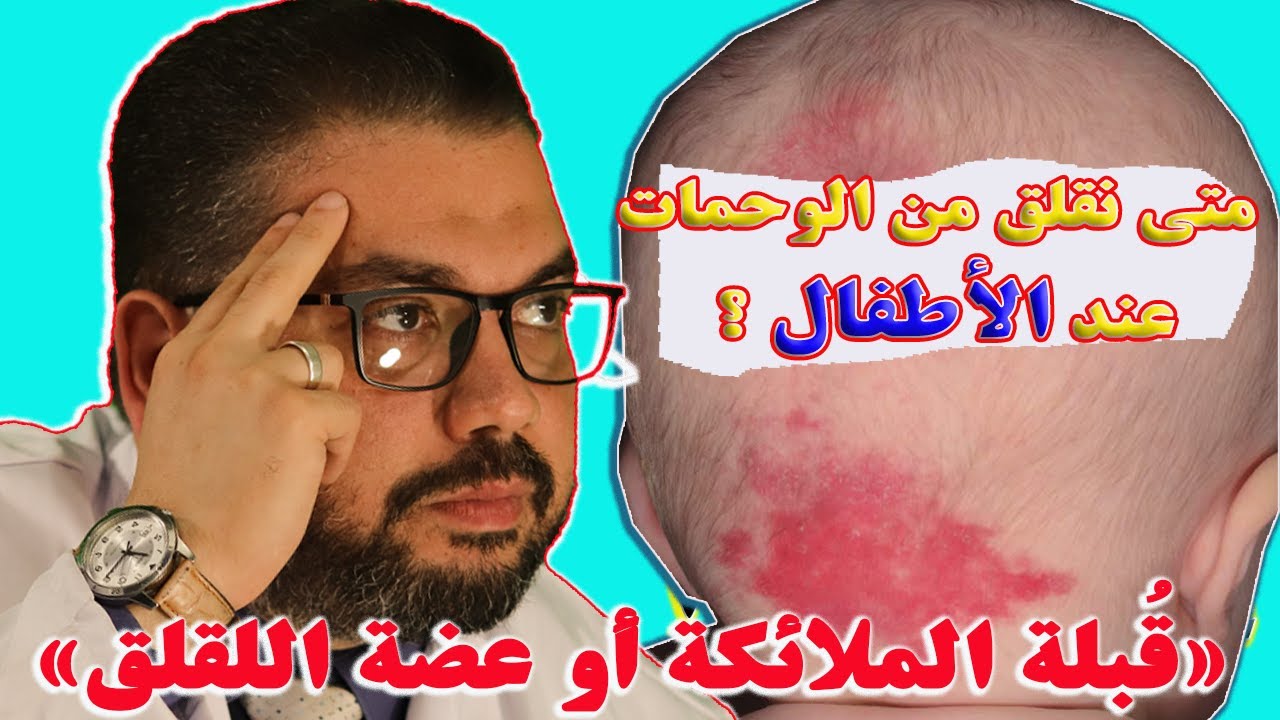 سر ظهور الوحمة لدى الطفل وطرق العلاج.. هل 