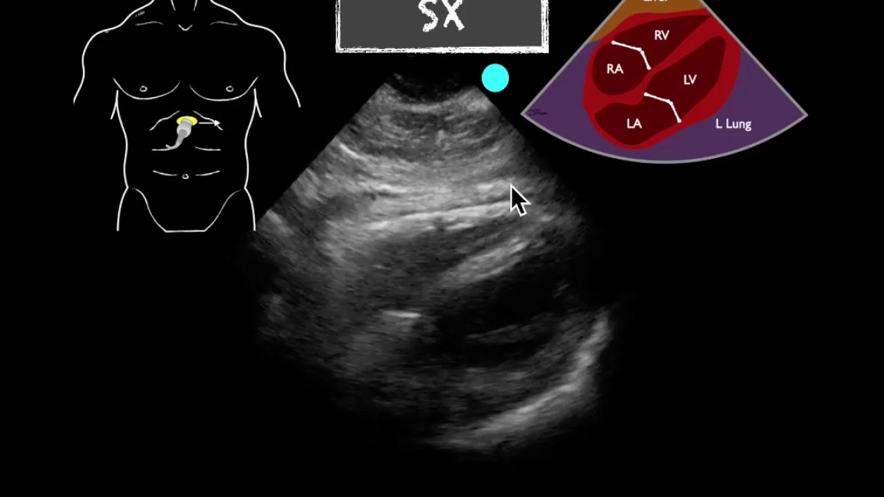 POCUS Teaching Point epicardial fat pad