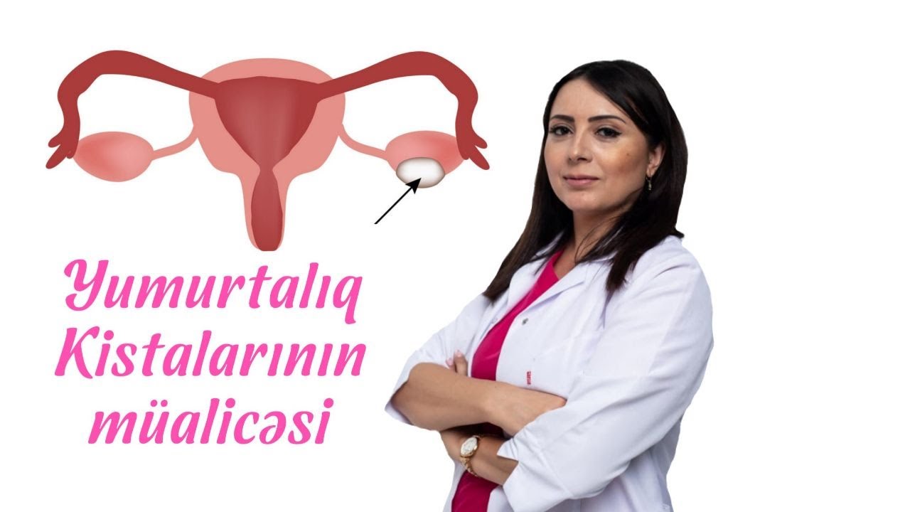 Yumurtalıq Kistalarının müalicəsi -  Dr İlahə Quliyeva