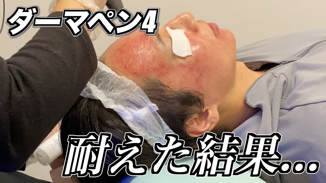 【ダーマペン 計3回！】毛穴やニキビ跡が改善した？施術や経過をまとめて紹介！