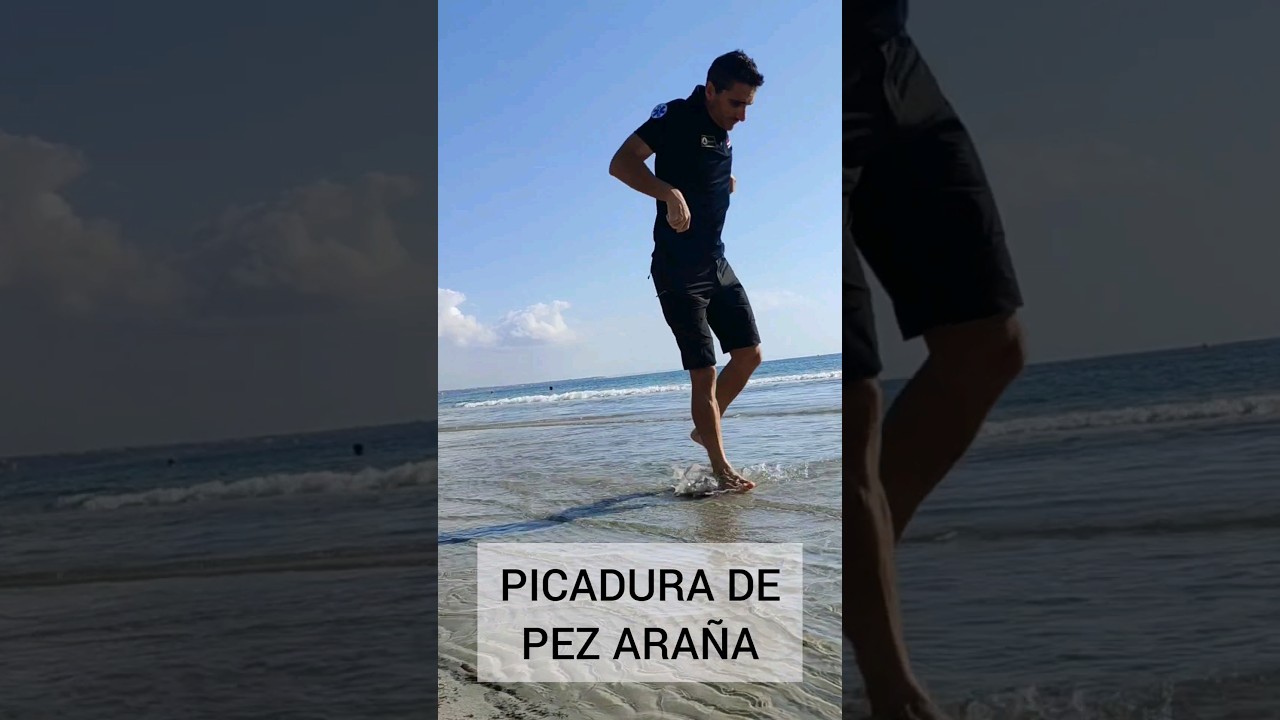 Picadura de pez araña. #supervivencia #emergencia #curiosidades