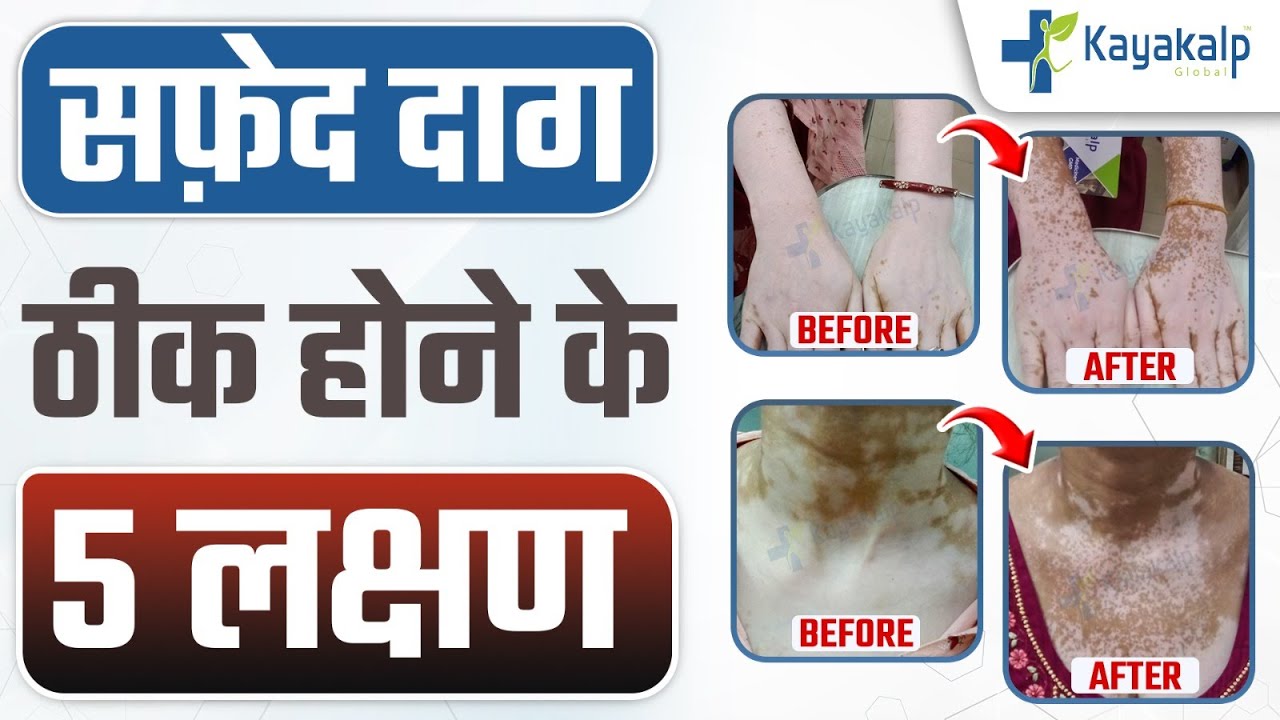 सफेद दाग ठीक होने के 5 संकेत | 5 Signs of Vitiligo Recovery| सफेद दाग ठीक होने में कितना समय लगता है