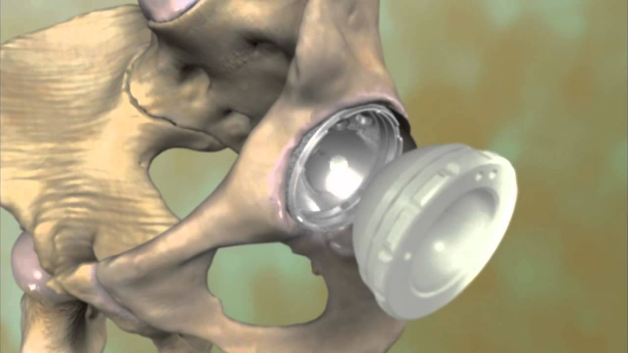 Total Hip Replacement