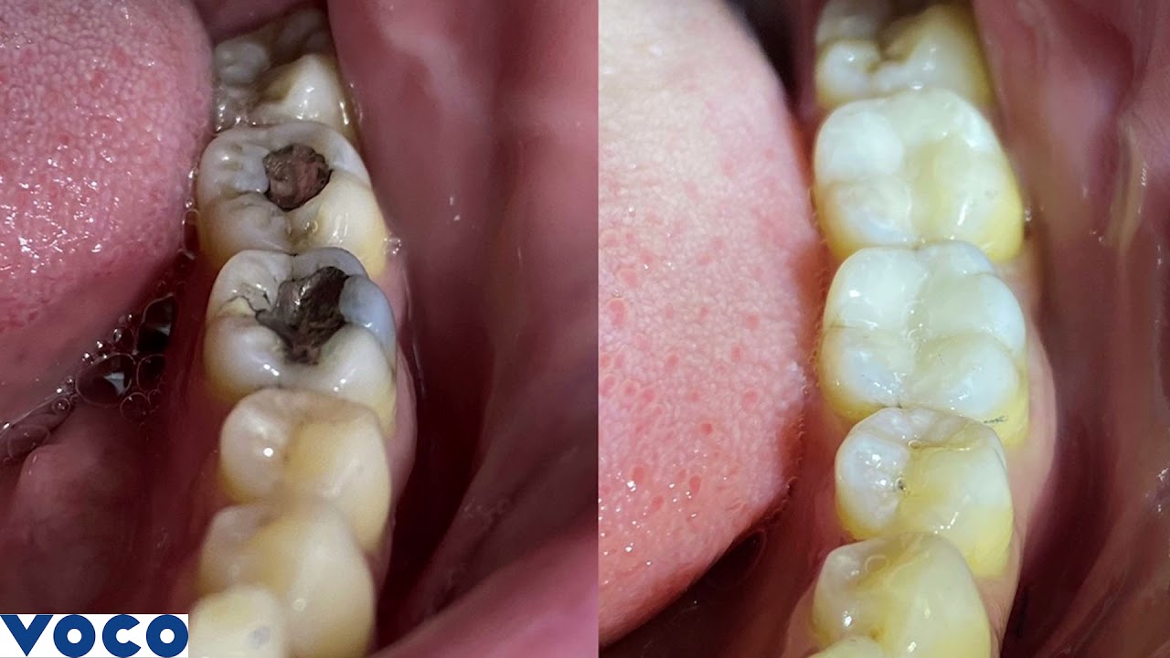 Aesthetic and biocompatible: Admira Fusion &ndash; the universal restorative material