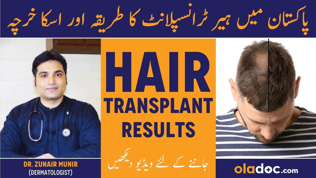 Hair Transplant Results - Cost Of Hair Transplant In Pakistan - Girte Baal Aur Ganjpan Ka Khatma