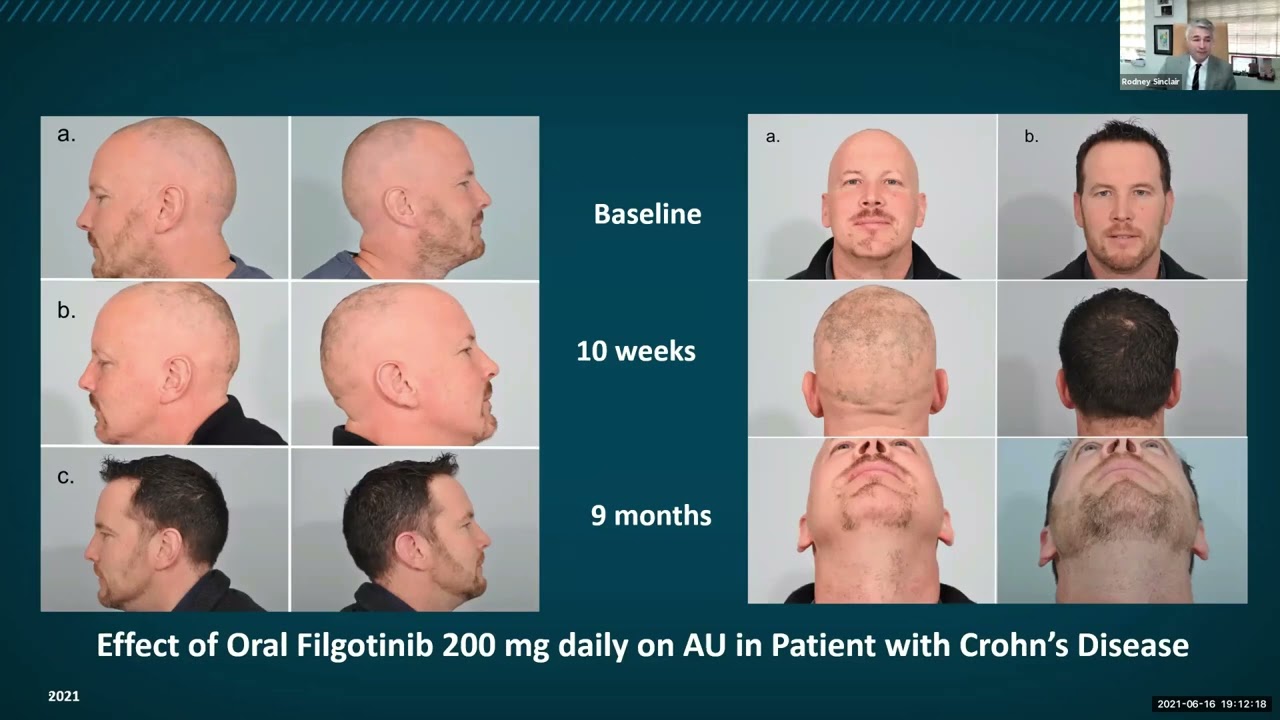 Alopecia Areata - Part Three: The Future