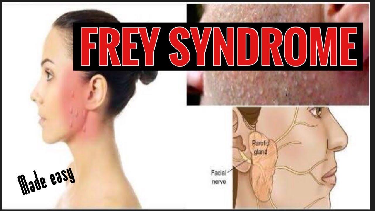 FREY SYNDROME II GUSTATORY SWEATING II AURICULOTEMPORAL SYNDROME II ORAL SURGERY