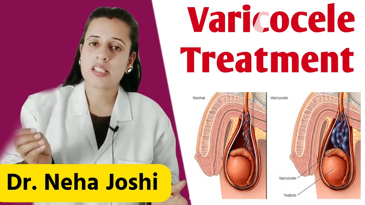 Permanent Treatment of Vari.cocele ● वृषण में सूजन की दवाई - Dr. Neha Joshi ✔ #nehajoshi #education