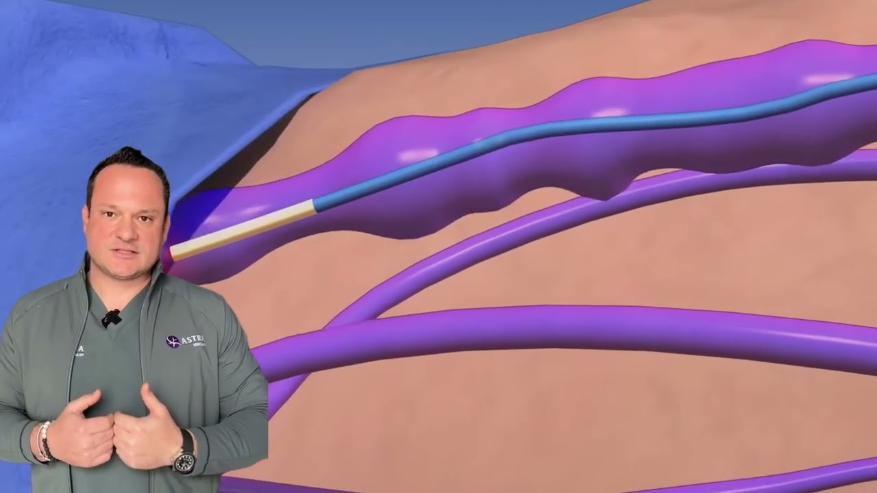 Endovenous Laser Ablation (EVLA) and Foam Sclerotherapy for the treatment of venous insufficiency