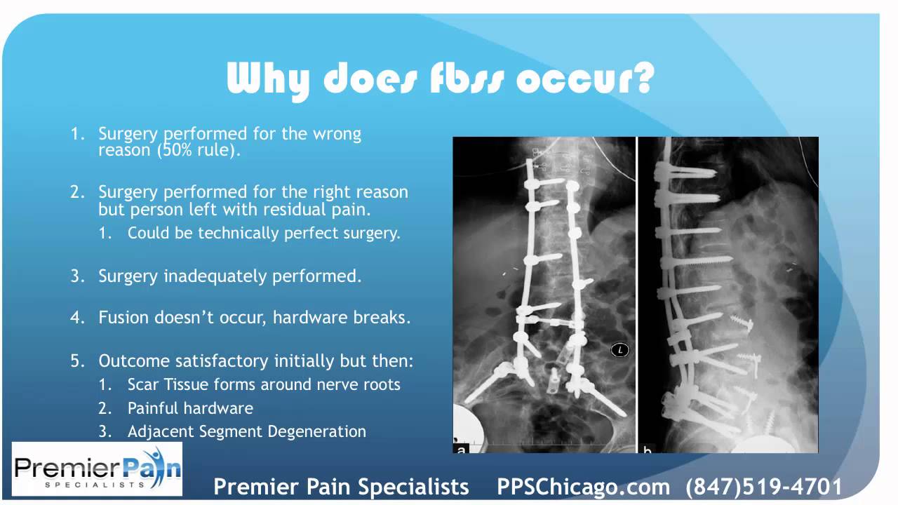 Failed Back Surgery Syndrome Treatment at a Chicago Pain Center (847) 519-4701