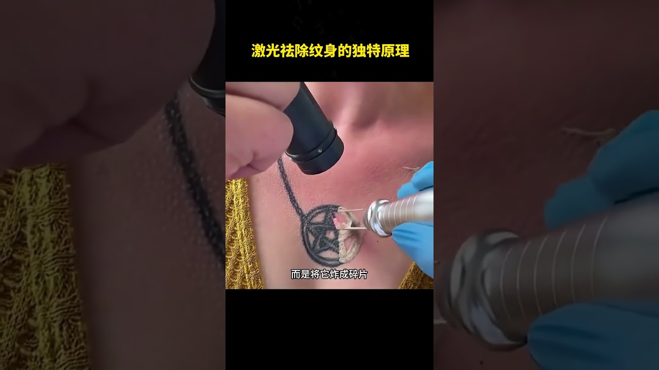 激光祛除纹身的独特原理 #世界探索 #科普
