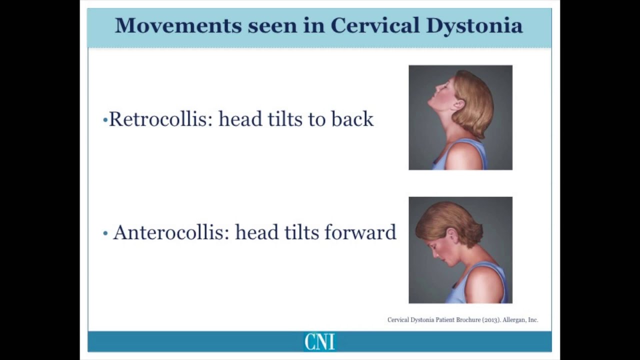 Part 4 - What is Cervical Dystonia?