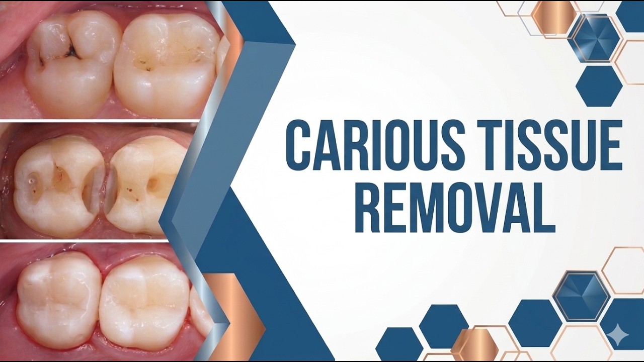 Carious Tissue Removal  - 2026