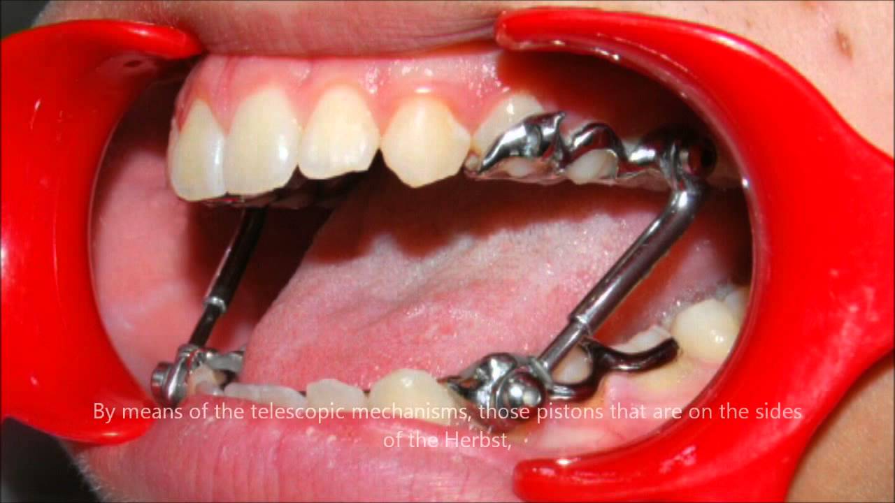 Presenting the Herbst appliance (An Introduction) | Tom Nasiopoulos Orthodontist
