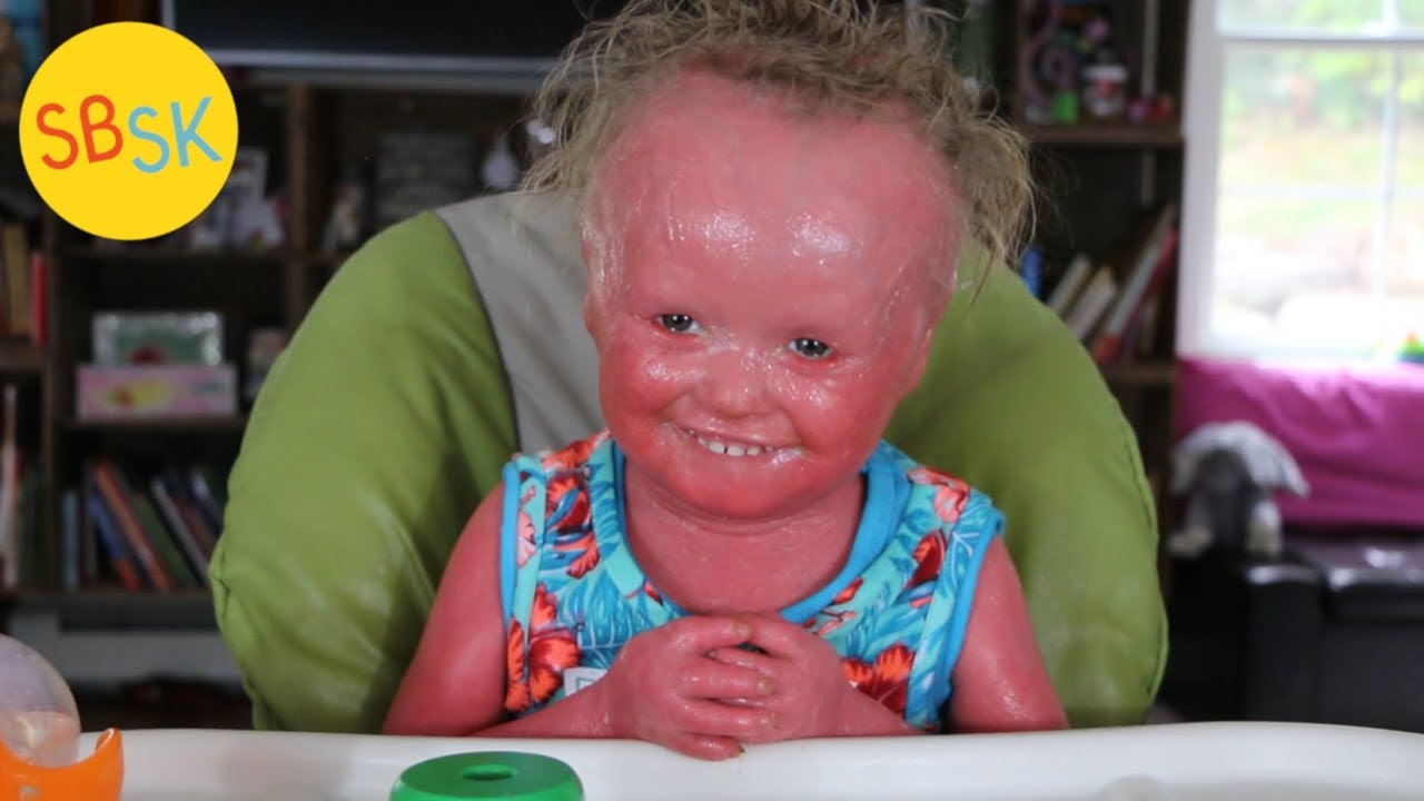 My Friend with Harlequin Ichthyosis (Skin that Grows Too Fast)
