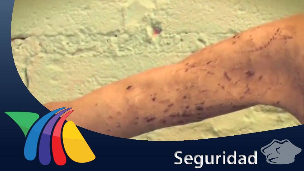 Mujer esclavizada requiere cirugía plástica | Noticias