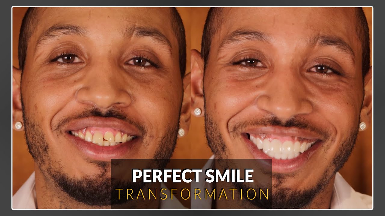 Protruded & Misaligned Teeth to Perfect Smile w/ Cosmetic Smile Veneers Brighter Image Lab