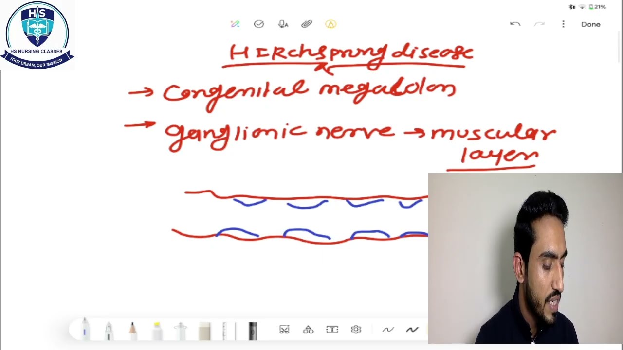 HIRCHSPRUNG DISEASE By Sandeep sir