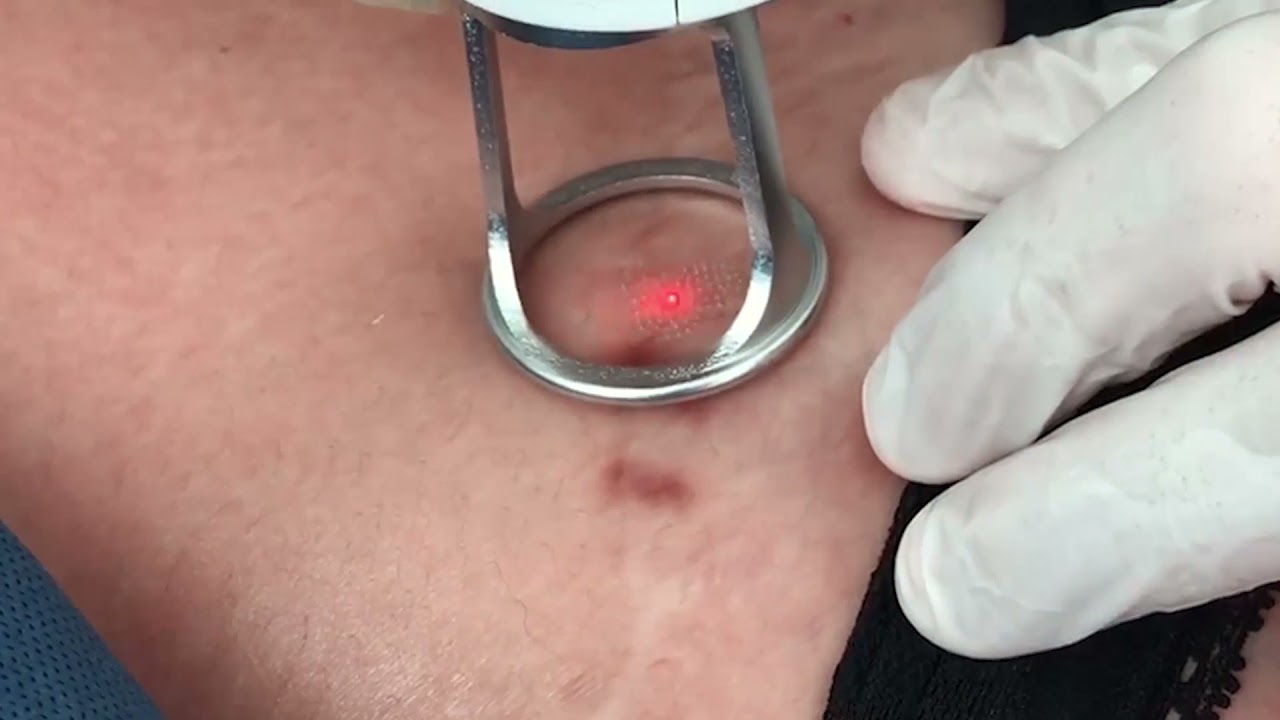 Láser Co2 en Abdominoplastia.