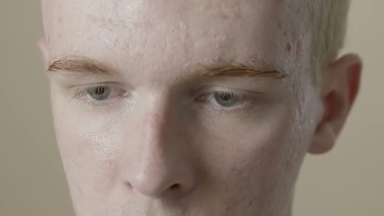 Stop Sabotaging Your Skin: Fix Acne Mistakes Now!