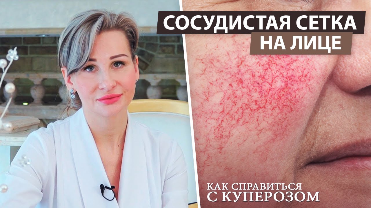 Купероз и его причины | Сосудистая сетка | Уход за кожей