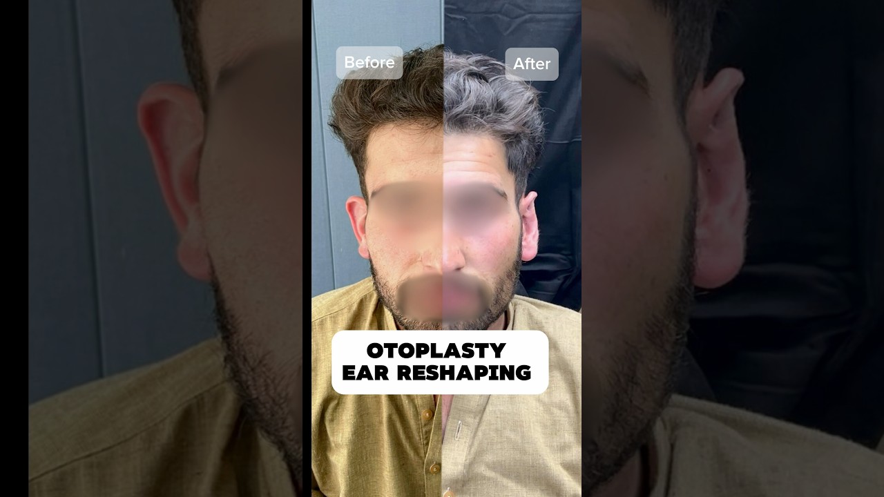 Otoplasty | Ear Reshaping Surgery | Before & After
