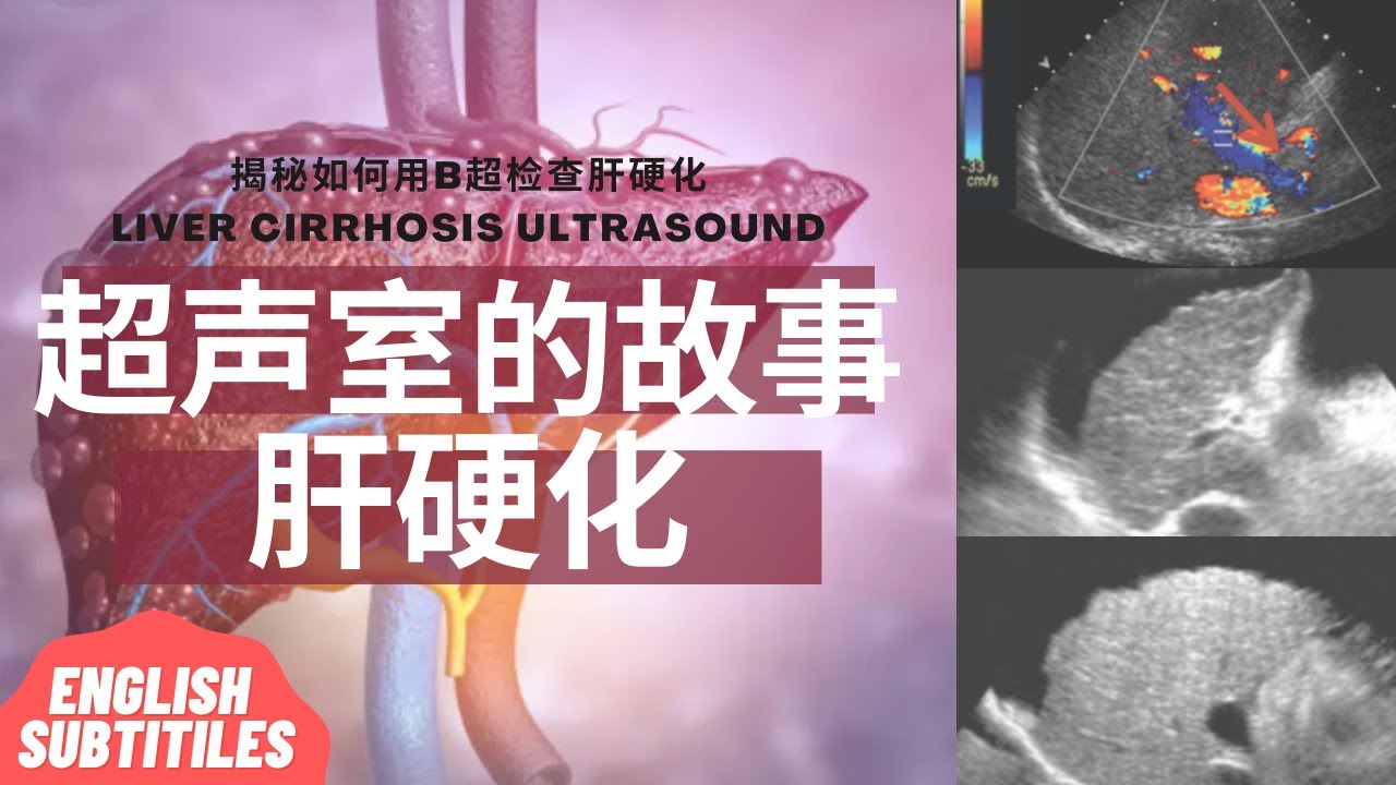 肝硬化：肝硬化是什么/肝硬化是如何形成的/ 常见症状和并发症/B超如何检查肝硬化/治疗方法/ 如何预防肝硬化保养肝脏【Ultrasound Room】Liver Cirrhosis