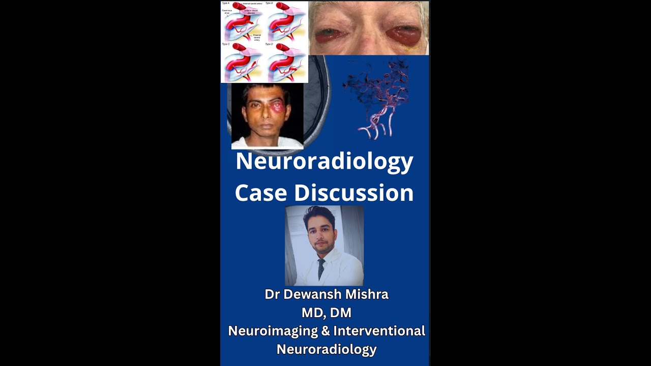 Indirect Carotid-Cavernous Fistula with 3rd nerve palsy. 