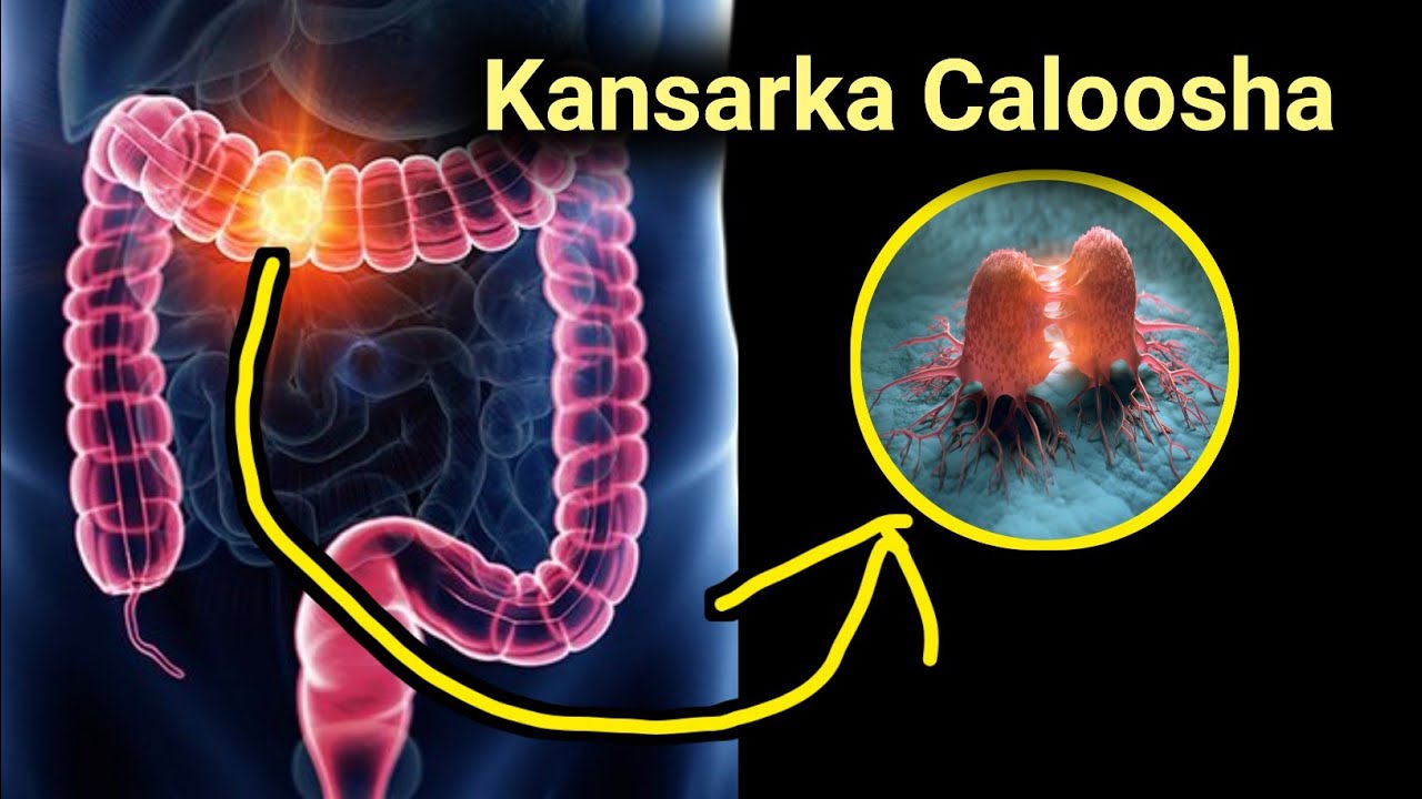 kansarka ku dhaca caloosha ama madhiciraha calaamadaha lagu garto iyo dhibaatooyinka ka dhasha