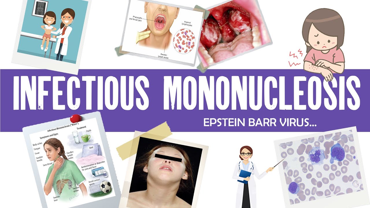 Infectious mononucleosis | Epstein Barr Virus | EBV | Atypical Lymphocytosis