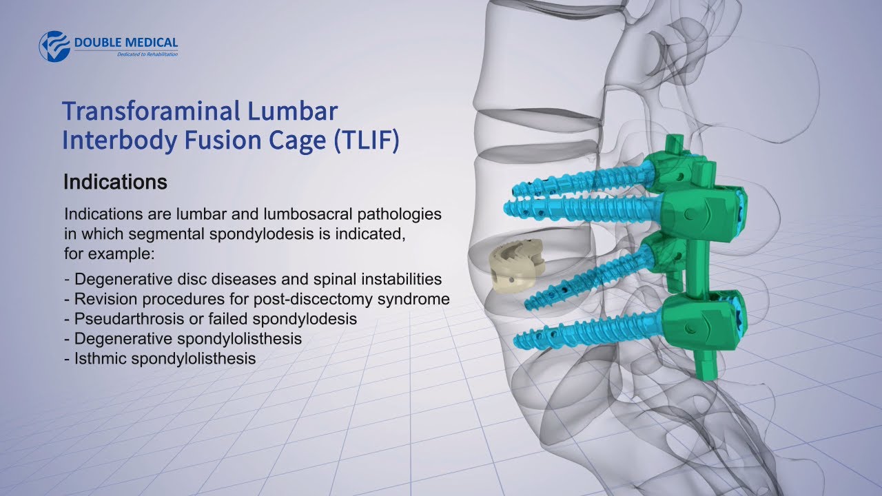 Double Medical Transforaminal Lumbar Interbody Fusion Cage (TLIF)
