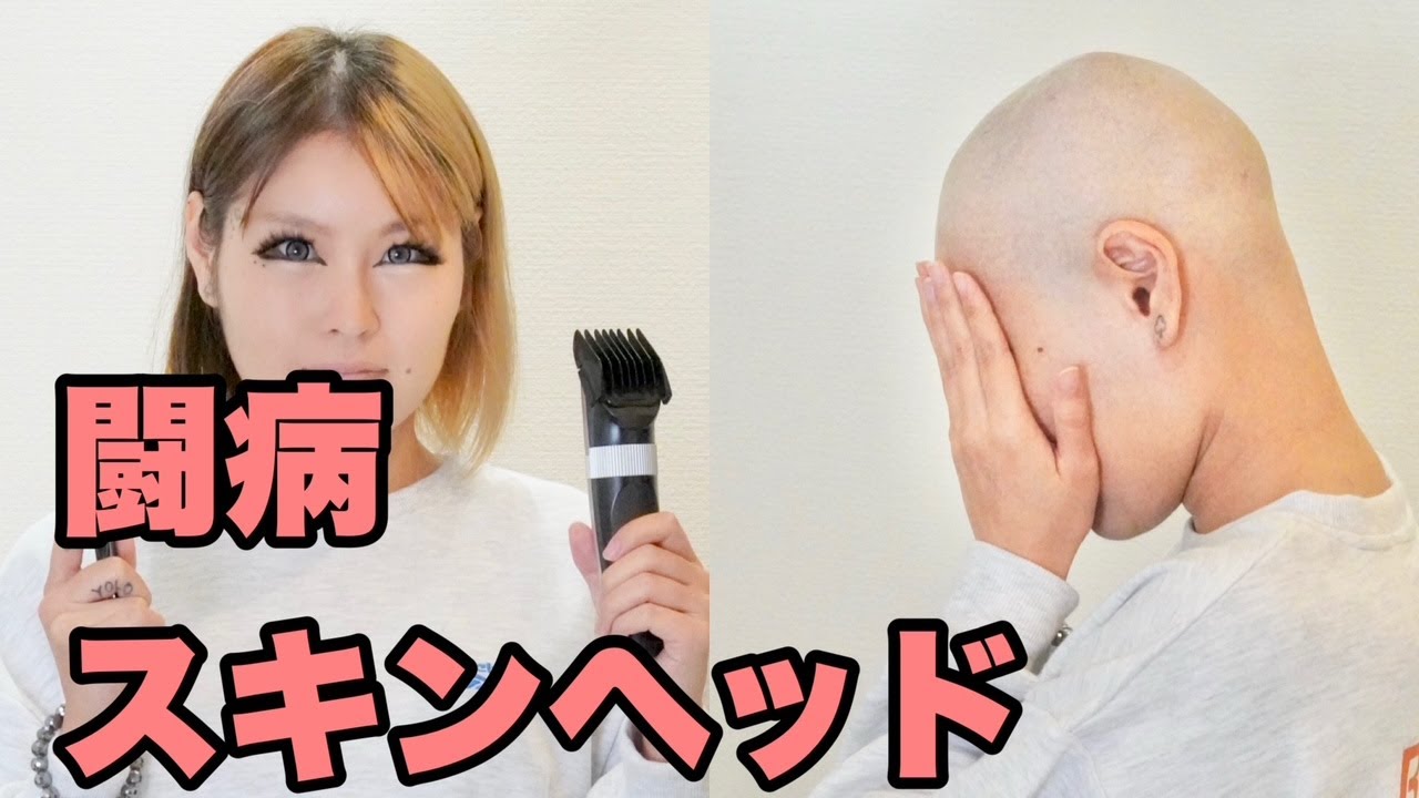 抗がん剤を打つのでスキンヘッド