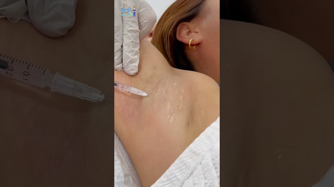 Botox for underarm sweating 