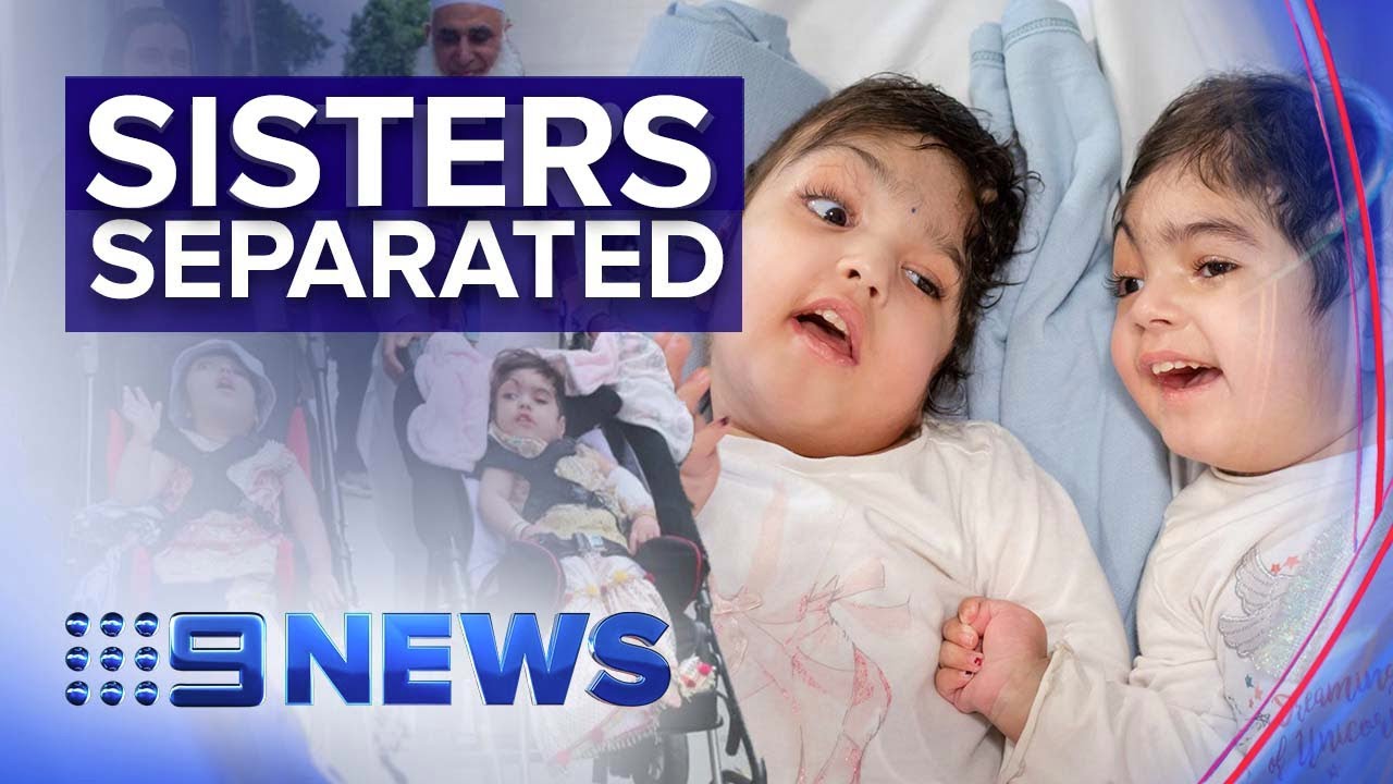 Doctors separate twins joined at the head in 50-hour operation | Nine News Australia