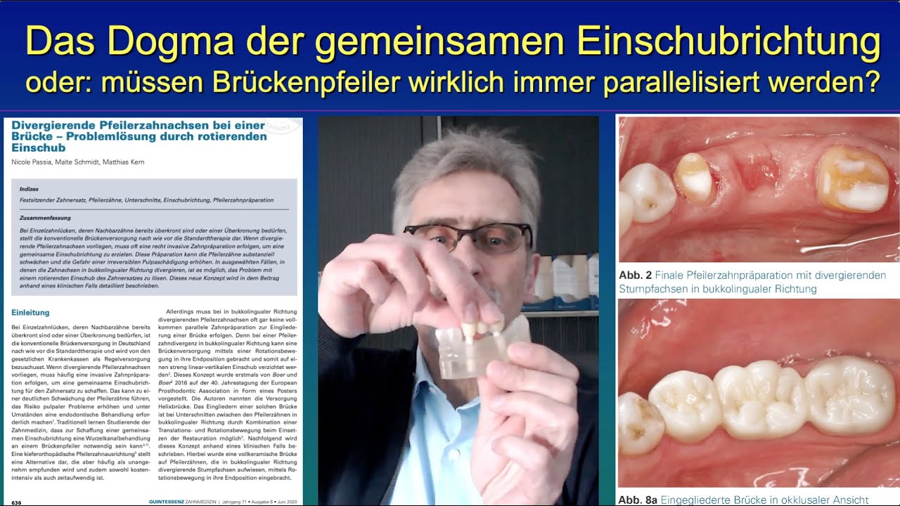 Das Dogma der gemeinsamen Einschubrichtung - was Generationen von Zahnärzten falsch gelehrt wurde