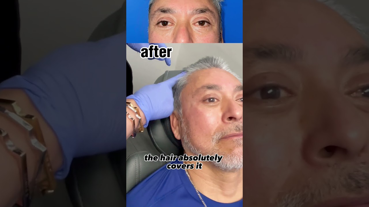 AMAZING but NATURAL:  Botox and eyelid surgery Board Certified Newport Beach Plastic Surgeon AfifiMD