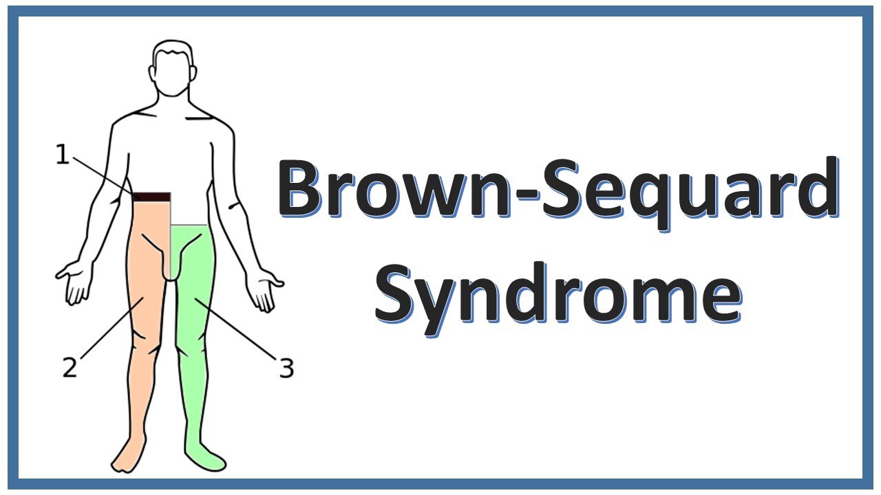 Brown-Sequard Syndrome | NEET PG | FMGE | USMLE