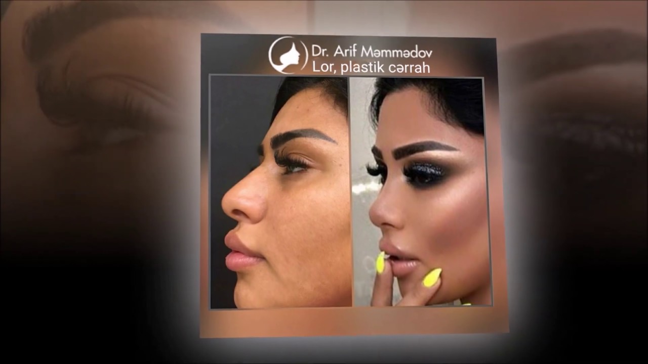 Rinoplastika əməliyyatından 3 ay sonra- Dr Arif Məmmədov Lor Plastik cərrah