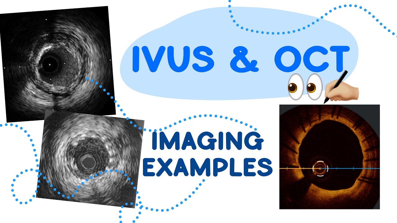 IVUS and OCT Plaque, Calcium and Stent Analysis