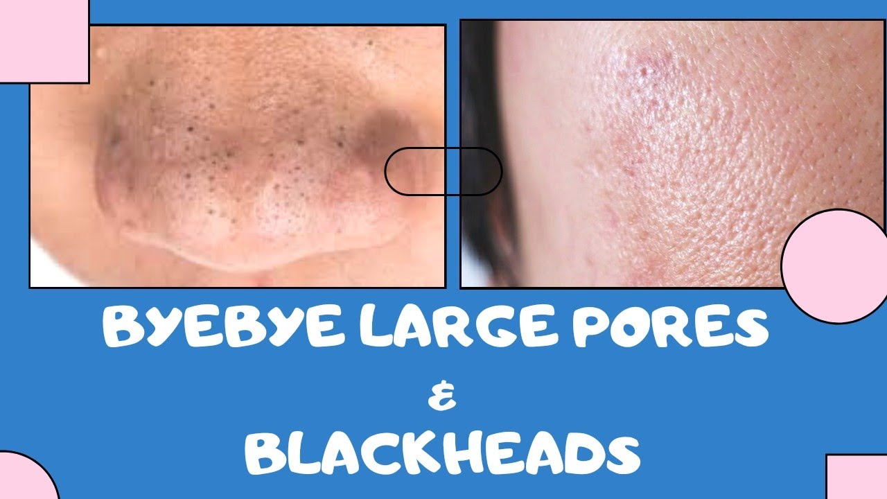 GET RID OF LARGE PORES & BLACKHEADS/ Eng subtitle.