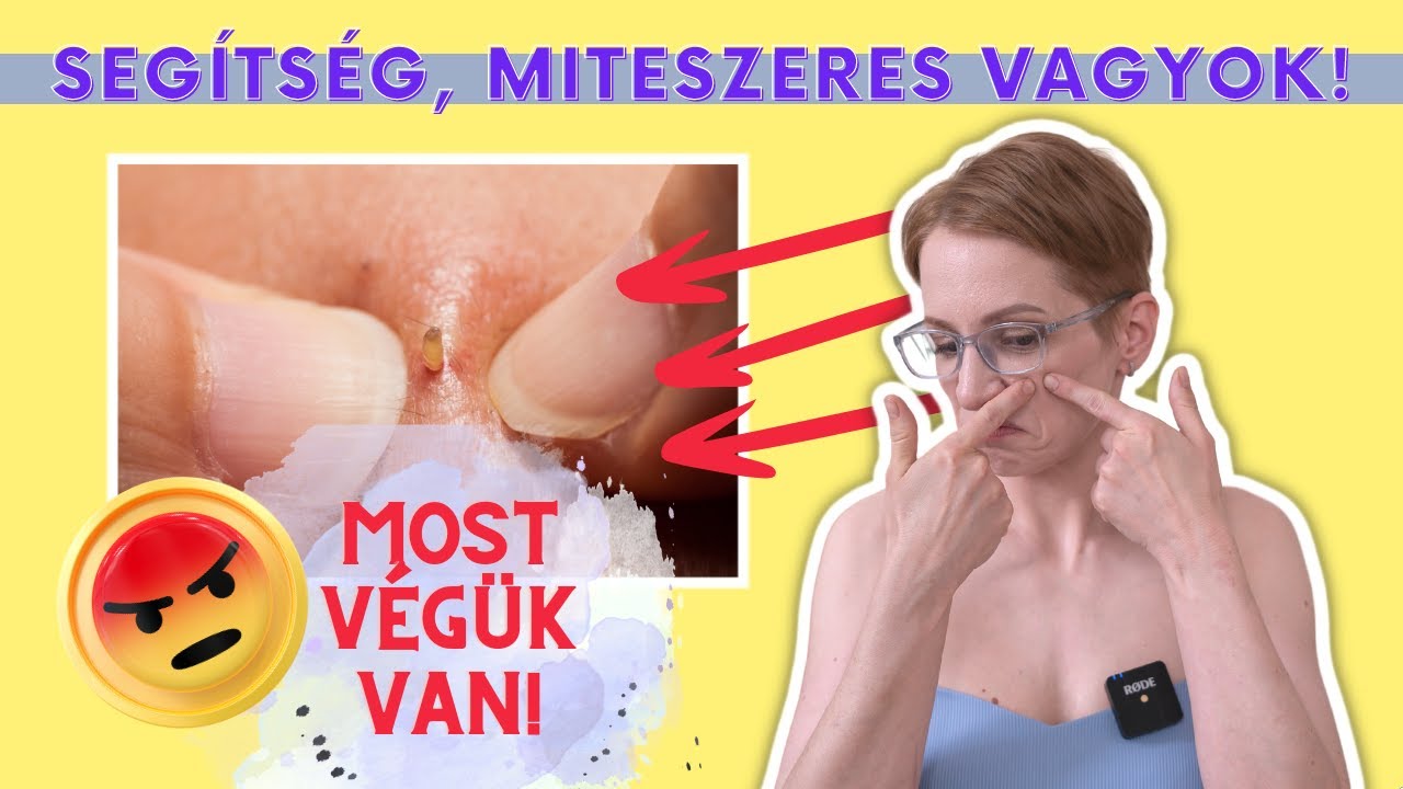 Harc a mitesszerek ellen: mi használ és mi nem?
