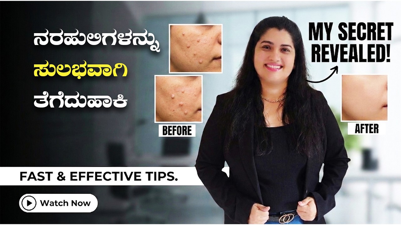 ನರಹುಲಿಗಳನ್ನು ಸುಲಭವಾಗಿ ತೆಗೆದುಹಾಕಿ | Fast and Effective Tips | Dr. Merlin