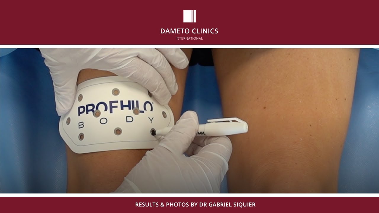 Profhilo Body Knees by Dr. Gabriel Siquier
