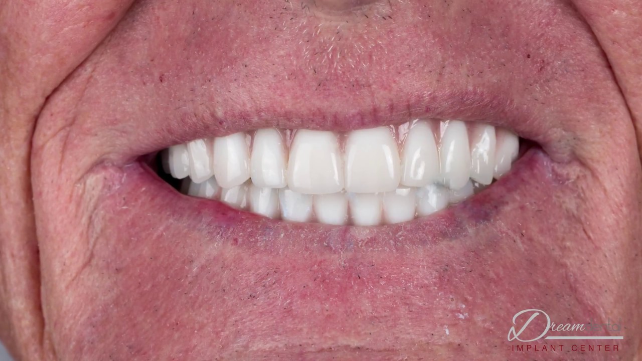 All on 4 Dental Implant Surgery Results from Dream Dental Implant Center